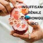 L’insuffisance rénale chronique (IRC)