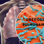Tuberculose pulmonaire: transmission, clinique et traitement