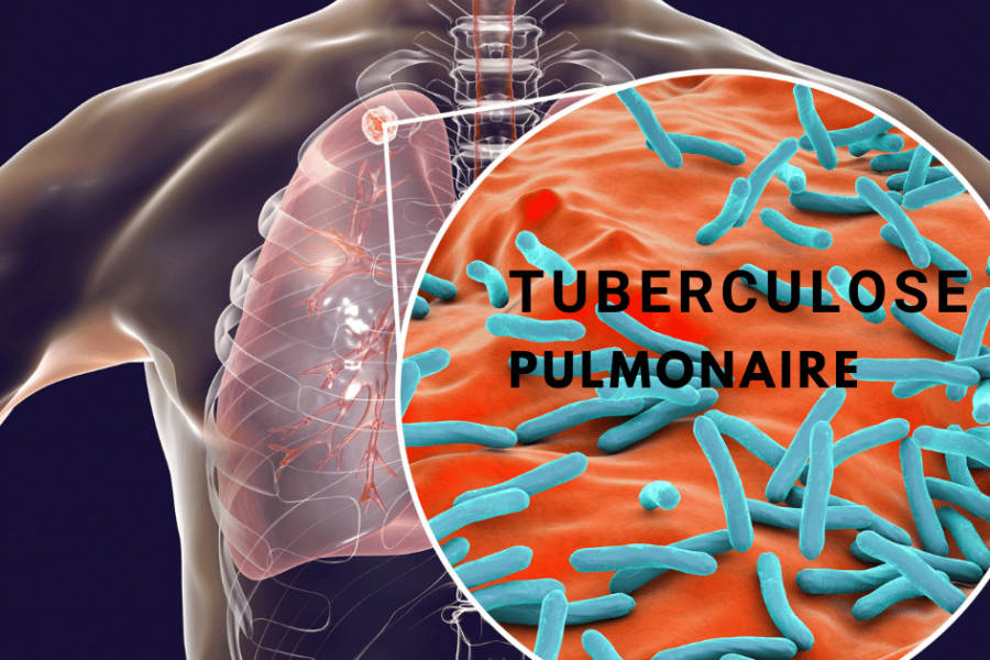 Tuberculose pulmonaire: transmission, clinique et traitement