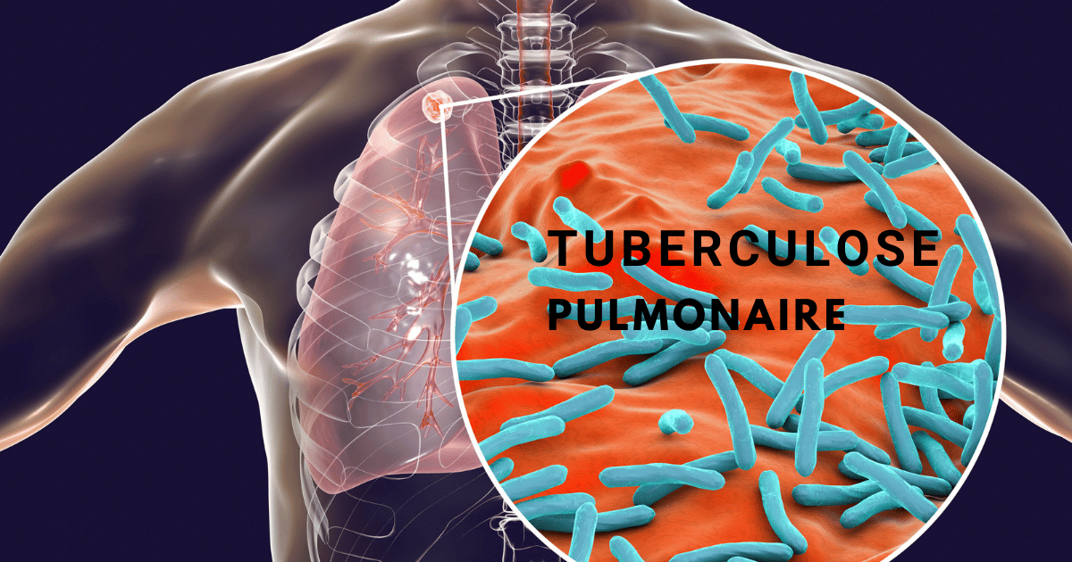 Tuberculose pulmonaire: transmission, clinique et traitement