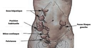 les 4 formes de l'appendicite