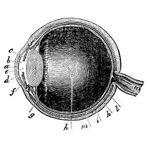 cataracte cortico-nucléaire