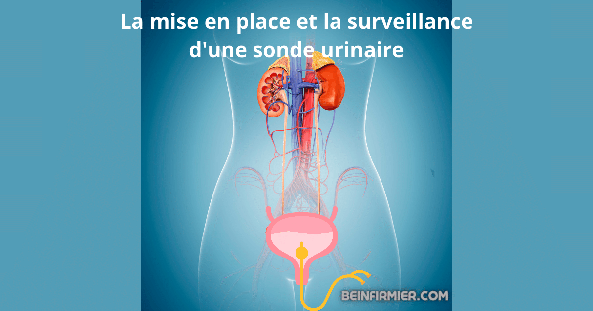 La mise en place et la surveillance d’une sonde urinaire