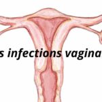 Présentation sur les infections vaginales les plus courantes