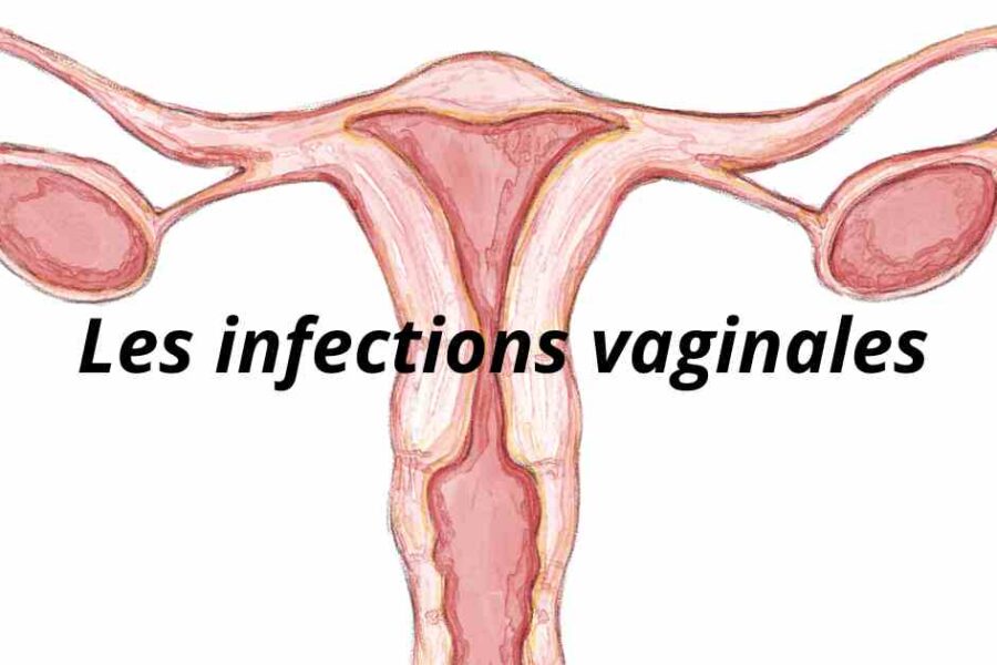 Présentation sur les infections vaginales les plus courantes