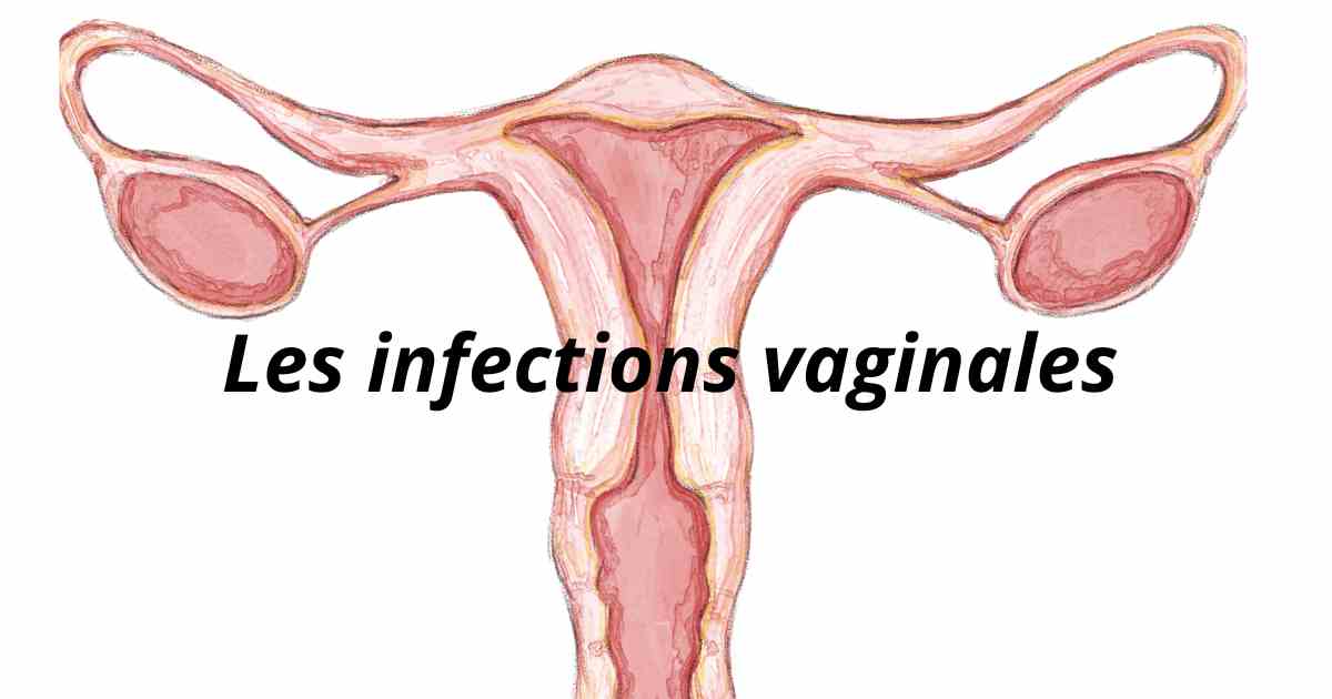 Présentation sur les infections vaginales les plus courantes