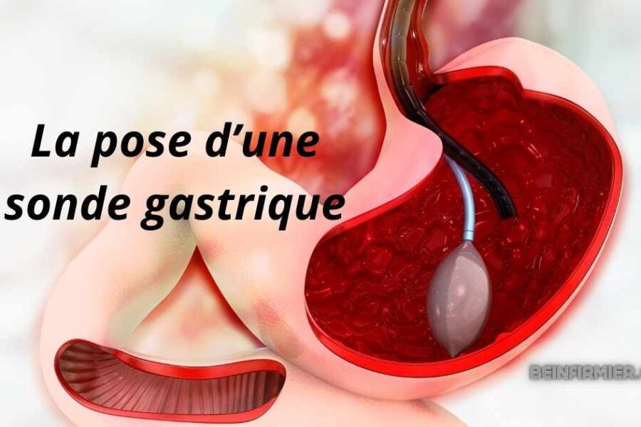 Sonde gastrique : pose, surveillance et recommandations