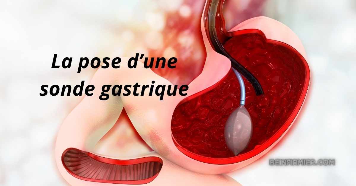 Sonde gastrique : pose, surveillance et recommandations