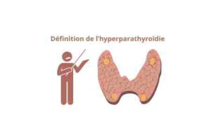 Définition de l’hyperparathyroïdie