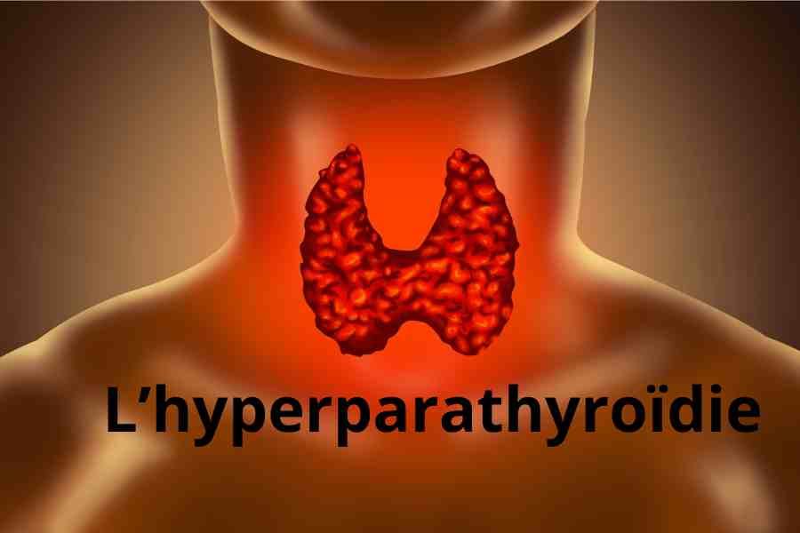 Hyperparathyroïdie (primaire, secondaire, tertiaire)