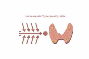 Les causes de l’hyperparathyroïdie